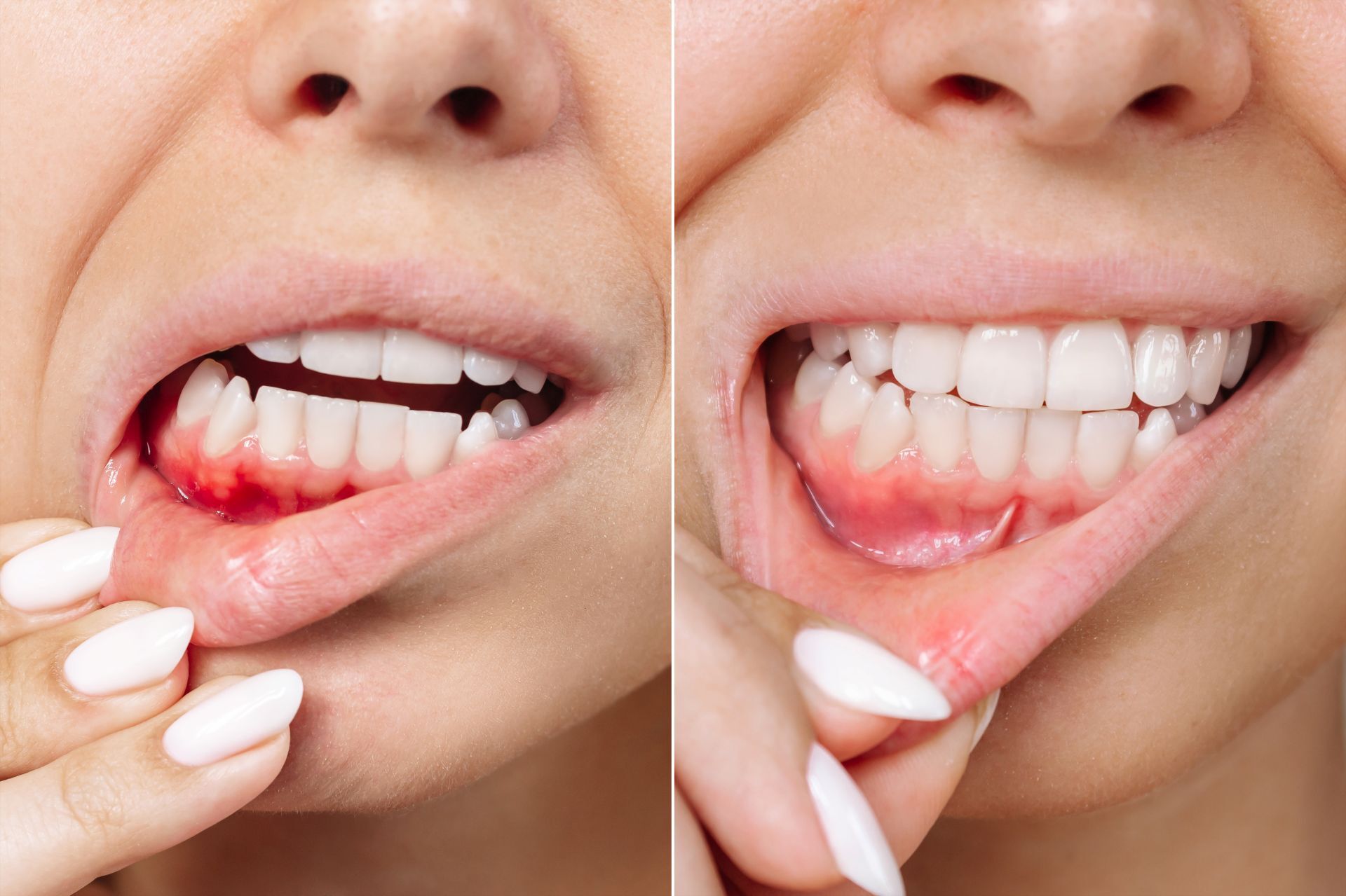 Vergleich: Entzündetes Zahnfleisch Vs. gesundes Zahnfleisch 